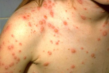Chickenpox Vaccine: Is It Necessary?