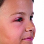 Pink Eye – Conjunctivitis – The Simple Details and Also The Cures