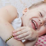 Chickenpox_How_to_Ease_the_Itch1