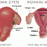 education-ovarian-cysts