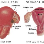 education-ovarian-cysts