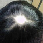 Alopecia areata