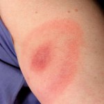 West Nile Virus Symptoms