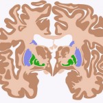cerebral-plasy-new