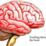 encephalitis