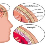 meningitis
