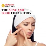 acne-and-food-connection