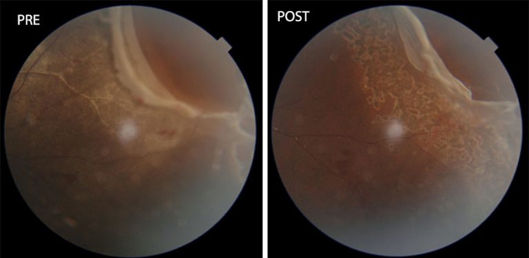 13-Year-Old Boy’s Vision Saved After Rare Eye Injury from Cricket Ball Treated at Aster Hospital Mankhool