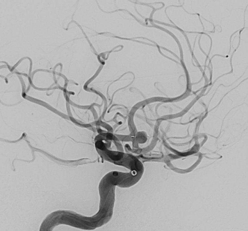 Cereberal Aneurysms Immediate Post Treatment