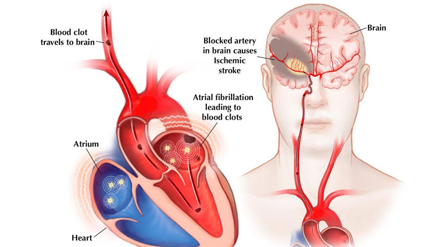 Atrial fibrillation